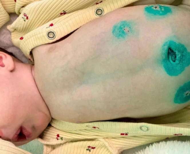 Двухнедельную девочку с аномалией кишечника спасли воронежские врачи
