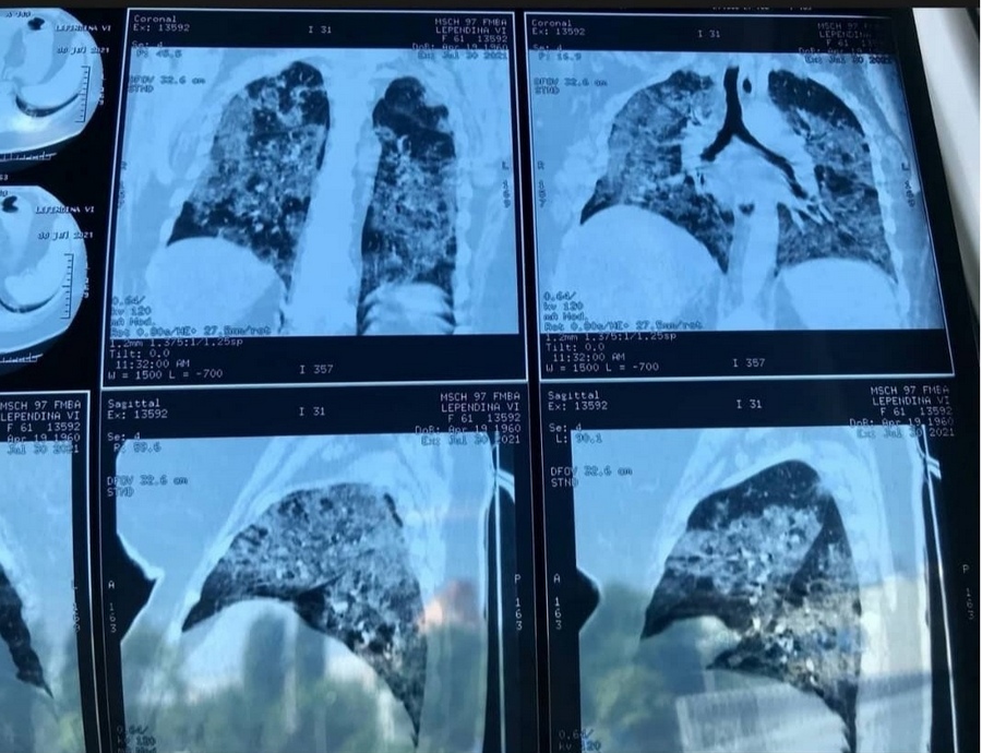 Фотографии поражённых на 96% ковидом лёгких показали воронежские врачи