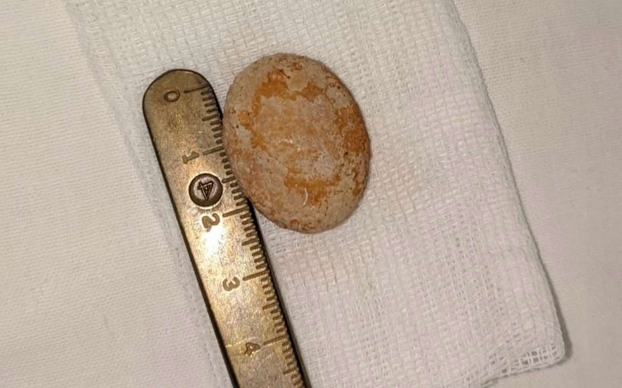 Воронежские врачи извлекли 3-сантиметровый камень из мочевого пузыря 1,5-годовалого ребёнка