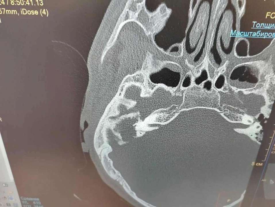 В Воронеже врачи вылечили 17-летнего пациента с крайне сложным отитом