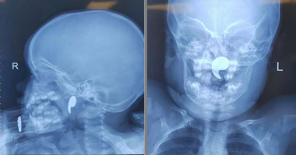 Из носоглотки 1,5-годовалой девочки воронежские медики извлекли магнит