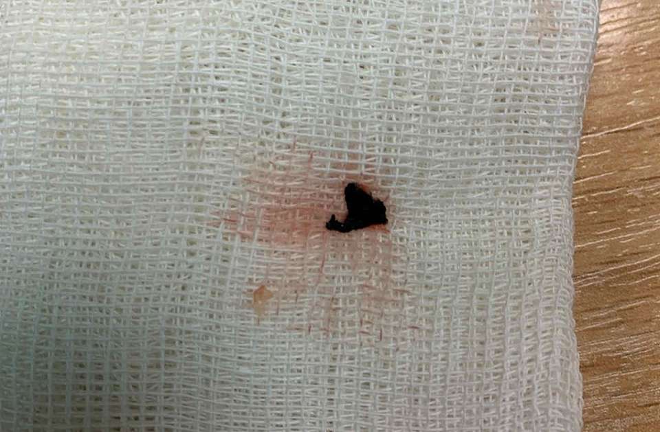 Из стопы подростка воронежские врачи достали кусок резиновой подошвы