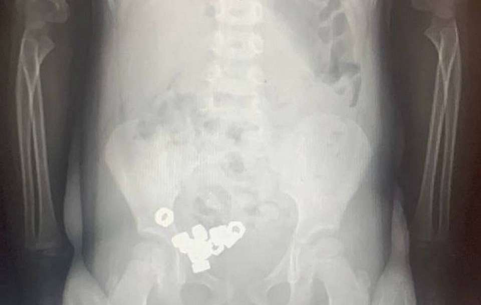 В Воронеже трехлетний мальчик проглотил стальных 16 гаек