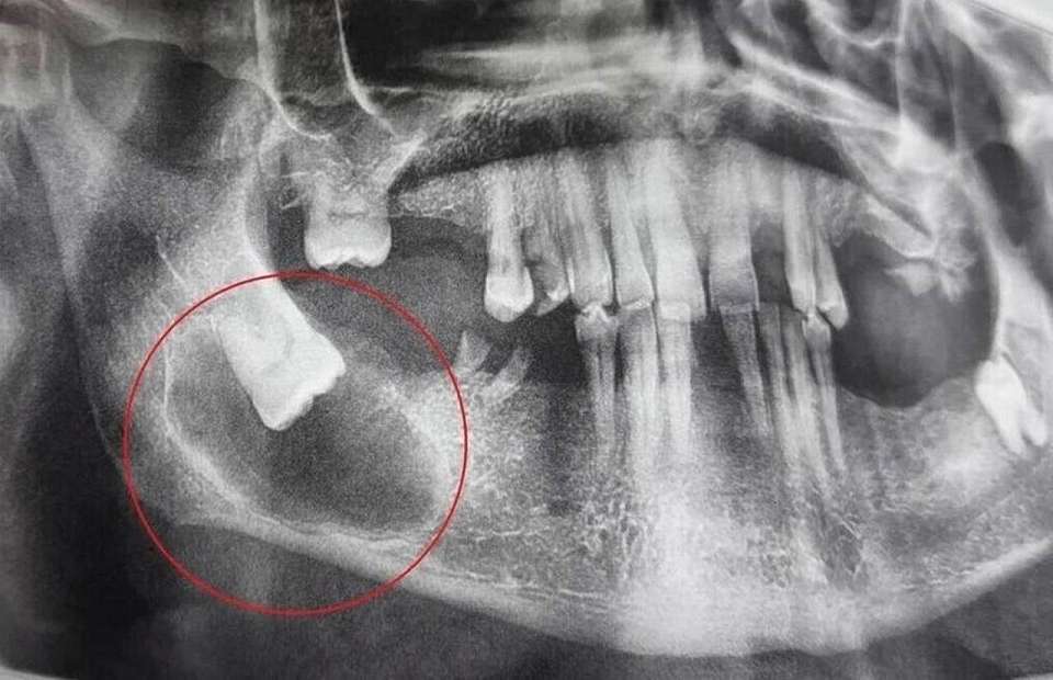 Воронежские стоматологи успешно удалили кисту и горизонтально росший зуб мудрости