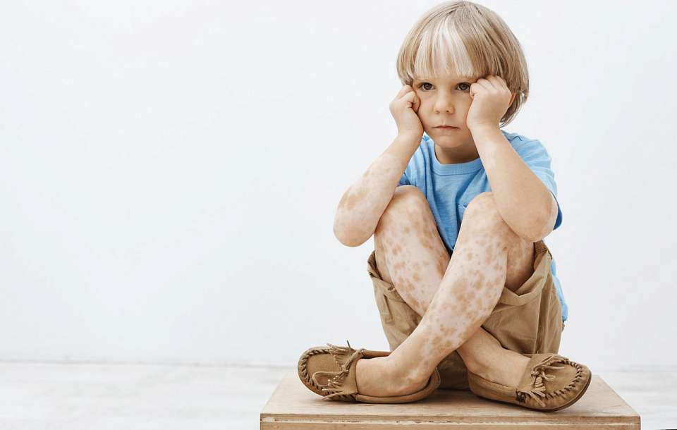 Заболеваемость ветрянкой в Воронежской области резко выросла