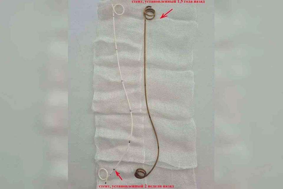 В Воронеже вросший в стенку мочеточника стент извлекли у пациента врачи