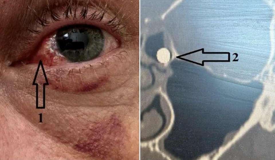 Пациенту с огнестрельным ранением глаза воронежские врачи сделали сложную операцию